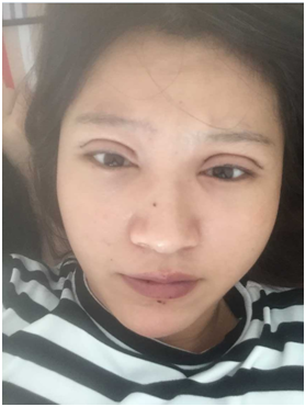 广州丽尚做的全切开双眼 变身混血儿