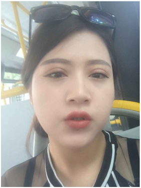 广州丽尚做的全切开双眼 变身混血儿