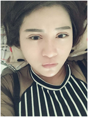 广州丽尚做的全切开双眼 变身混血儿