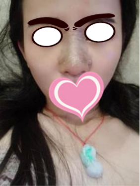 膨体隆鼻公改变了我塌鼻子的命运