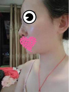 膨体隆鼻公改变了我塌鼻子的命运