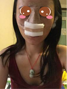 膨体隆鼻公改变了我塌鼻子的命运