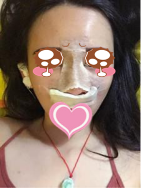 膨体隆鼻公改变了我塌鼻子的命运