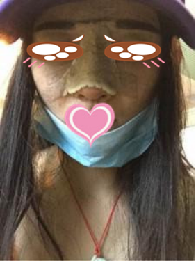 膨体隆鼻公改变了我塌鼻子的命运