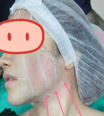 做了拉皮除皱 我的皮肤越来越紧致光滑了