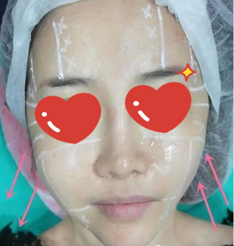 做了拉皮除皱 我的皮肤越来越紧致光滑了