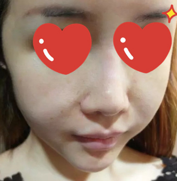 做了拉皮除皱 我的皮肤越来越紧致光滑了