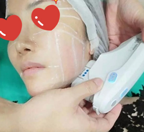 做了拉皮除皱 我的皮肤越来越紧致光滑了