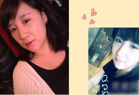 北京清木隆鼻+双眼皮恢复日记