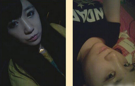 北京清木隆鼻+双眼皮恢复日记