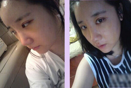 北京清木隆鼻+双眼皮恢复日记