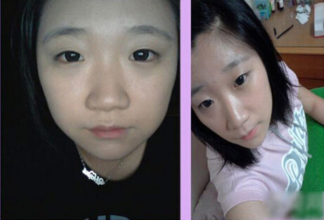 北京清木隆鼻+双眼皮恢复日记