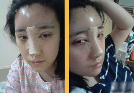 北京清木隆鼻+双眼皮恢复日记