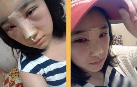 北京清木隆鼻+双眼皮恢复日记