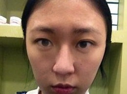 北京清木隆鼻整形后 **变身