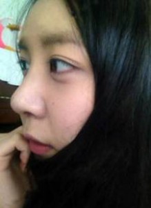 北京清木隆鼻整形后 **变身