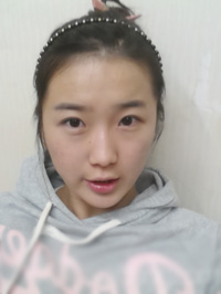 北京清木自体脂肪丰面颊2个月果分享