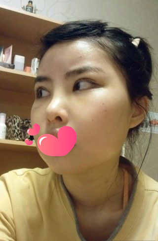 做了磨颧骨手术的我从小鸭子变成白天鹅 谢谢柳大烈教授