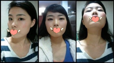 做了磨颧骨手术的我从小鸭子变成白天鹅 谢谢柳大烈教授