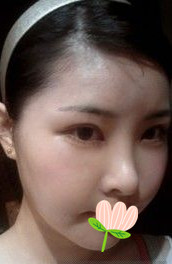 做了磨颧骨手术的我从小鸭子变成白天鹅 谢谢柳大烈教授