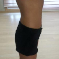 北京清木腰腹吸脂3个月感受