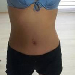 北京清木腰腹吸脂3个月感受