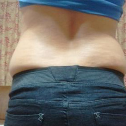 北京清木腰腹吸脂3个月感受