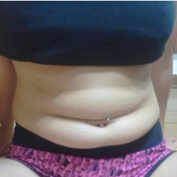 北京清木腰腹吸脂3个月感受