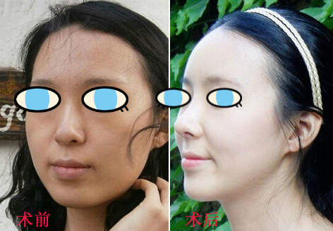 做了膨体隆鼻我也有了高鼻梁 **