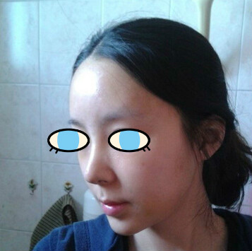 做了膨体隆鼻我也有了高鼻梁 **