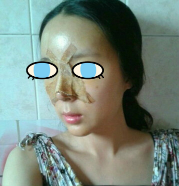 做了膨体隆鼻我也有了高鼻梁 **