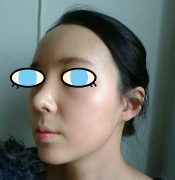 做了膨体隆鼻我也有了高鼻梁 **