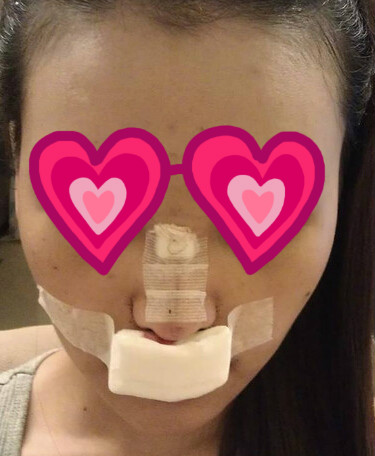 耳软骨隆鼻加缩鼻翼 让我的颜值提升好几个档次