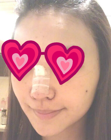 耳软骨隆鼻加缩鼻翼 让我的颜值提升好几个档次