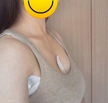 北京世熙自体脂肪隆胸2个月啦~