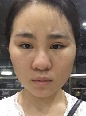 做鼻子之前的照片,鼻子真的是辣眼睛啊,太丑了.