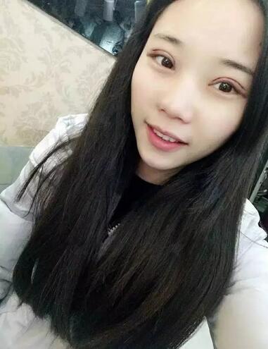 成都蜀尚蓉雅双眼皮恢复纪实 看看果怎么样