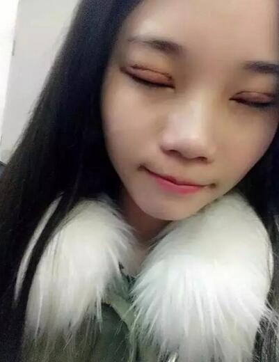 成都蜀尚蓉雅双眼皮恢复纪实 看看果怎么样