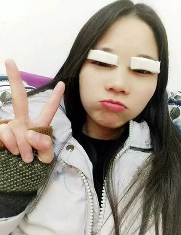 成都蜀尚蓉雅双眼皮恢复纪实 看看果怎么样