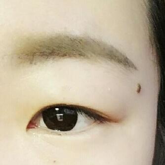 双眼皮恢复过程分享