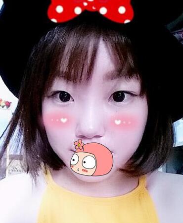 双眼皮恢复过程分享