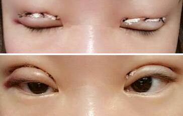 双眼皮恢复过程分享