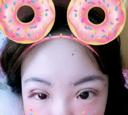 双眼皮恢复过程分享