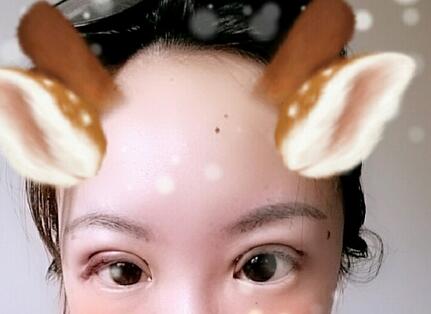 双眼皮恢复过程分享
