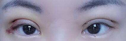 双眼皮恢复过程分享