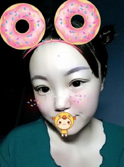 双眼皮恢复过程分享