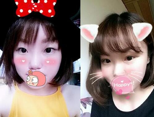 双眼皮恢复过程分享