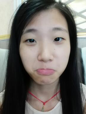 双眼皮15天恢复记录