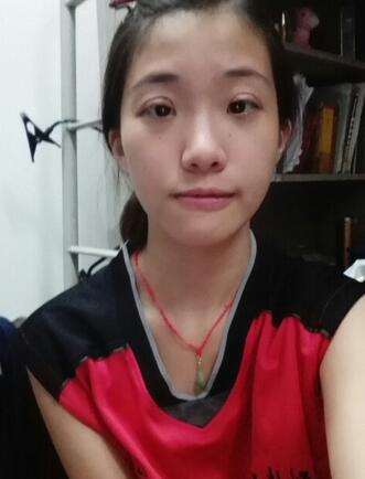 双眼皮15天恢复记录