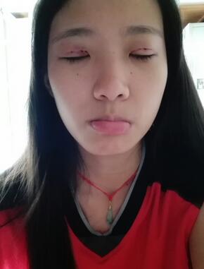 双眼皮15天恢复记录